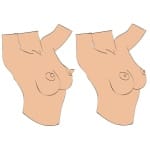 Βεντούζες Θηλών Nipple sucker